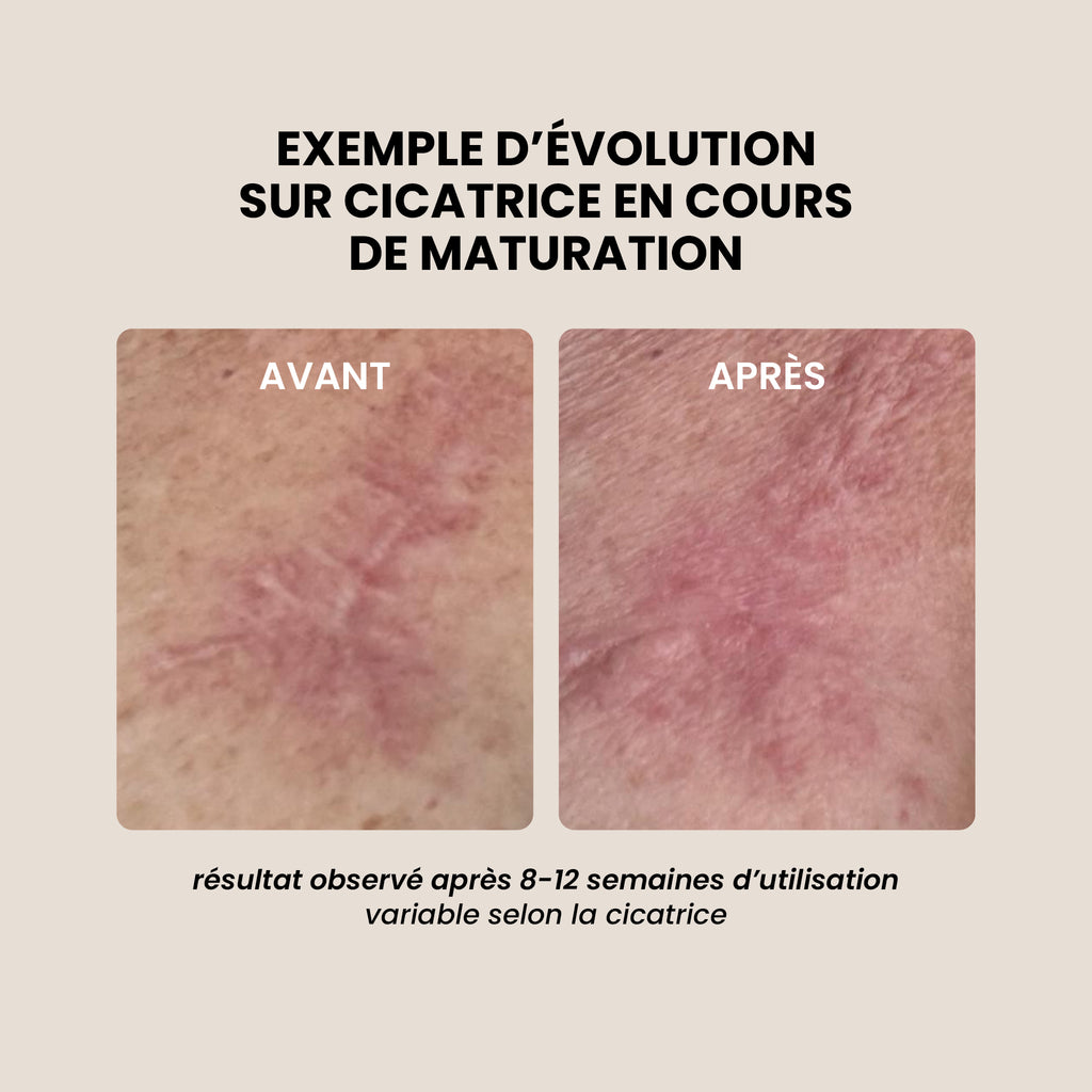 Revéra Soin - stick silicone cicatrices